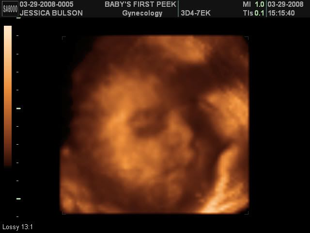 3d ultrasound pictures at 26 weeks. 26-32 week 3D ultrasound pics