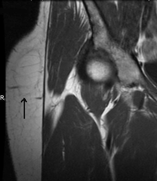 Lipoma